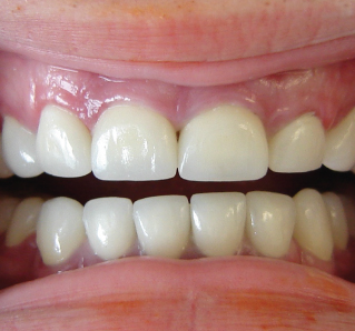 ทันตกรรมบูรณะ (Operative Dentistry) ทันตกรรมบูรณะ (Operative Dentistry)